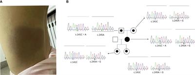 Case Report: HAVCR2 mutation-associated Hemophagocytic lymphohistiocytosis